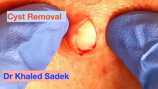 Cyst Removal Eye Ball Dr Khaled Sadek LipomaCystcom [upl. by Siloa62]