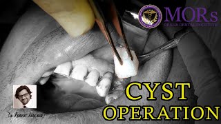 Dental Cyst Removal case6 牙囊肿 [upl. by Thilda]