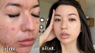 My Accutane Journey  Raw Footage Before and After [upl. by Chil]