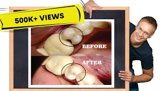 Class II cavity restoration  STEPBYSTEP [upl. by Doownil]