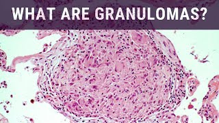 Vasculitis Pathology Diagnosis and Treatment  Ep 2 [upl. by Emanuel]