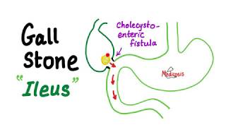 Gall Stone Ileus [upl. by Ynna]