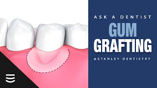 Ask a Dentist Gum Grafting 101 [upl. by Jareb261]