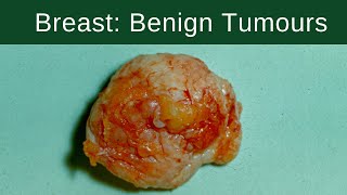 Breast Carcinoma Invasive  Pathology mini tutorial [upl. by Adekram]