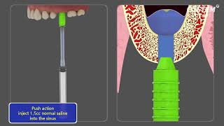 CAS KIT Crestal Approach  Sinus KIT [upl. by Elay]