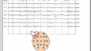 EEG  101 [upl. by Eislrahc348]