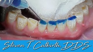 Bonding Worn Anterior Teeth  Dental Minute with Dr Steven T Cutbirth DDS [upl. by Dde409]