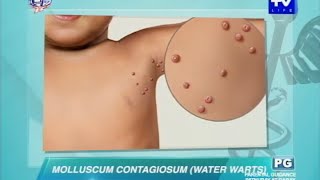 UNTV Life What causes water warts in adults and kids [upl. by Eneloj]