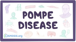 Pompe disease  causes symptoms diagnosis treatment pathology [upl. by Esineg]