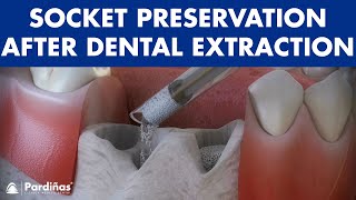 Tooth extraction  Treatment for socket preservation © [upl. by Thia834]