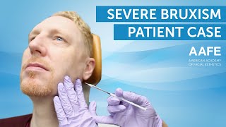 Treating Bruxism with Botox  AAFE [upl. by Etteneg]