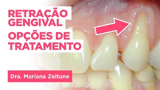 Retração ou Afastamento Gengival Opções de Tratamento  Dra Mariana Zeitune [upl. by Clevie]