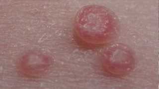 How to treat Molluscum Contagiosum [upl. by Marcie]