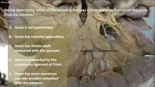 GENERAL SURGERY Small bowel obstruction vs large bowel obstruction vs Ileus [upl. by Cirdahc]