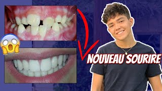 TOUT SUR MES DENTS évolution douleurs [upl. by Ennaitak627]