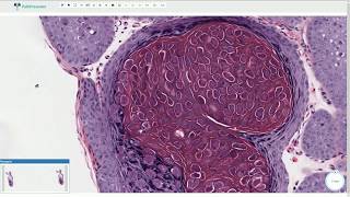 Molluscum Contagiosum  Histopathology [upl. by Arutek]