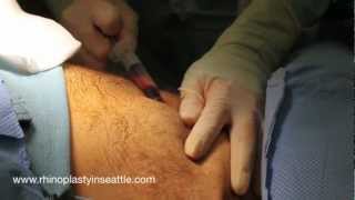 Fat Graft Harvest and Processing  Seattle Facial Fat Grafting [upl. by Asiuol]