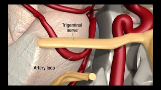 Occipital Neuralgia treatment options [upl. by Yragerg]