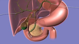 Introduction to Biliary Ultrasound [upl. by Yhotmit407]