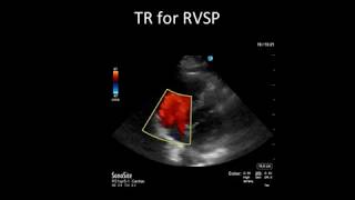 Principles of Doppler Ultrasound [upl. by Ajiak488]