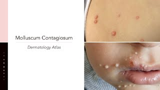 Molluscum Contagiosum [upl. by Bambi31]