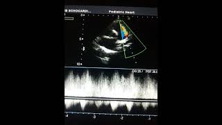 PATENT DUCTUS ARTERIOSUS  NCLEX REVIEW [upl. by Juana]