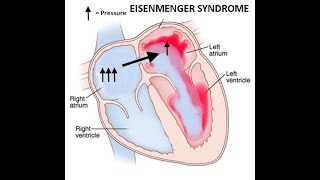 What is Eisenmenger syndrome  Circulatory System and Disease  NCLEXRN  Khan Academy [upl. by Ahsilyt]