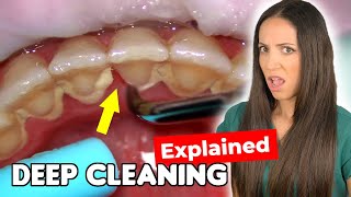 Dental Hygienist Explains Deep Cleaning Procedure [upl. by Lenehc]