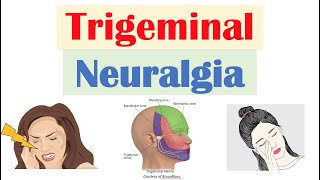 Occipital neuralgia  Symptoms amp Treatments so EVERYBODY Understands [upl. by Yorgerg]