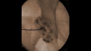 IntraArticular Hip Injection Using Anatomic Surface Landmarks [upl. by Elohcin823]