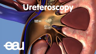 Removal of kidney stones URS [upl. by Onaimad]