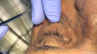 Milia  Stringoma Removal  Periorbital Area [upl. by Luemas]