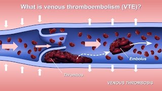 DeepVein Thrombosis A Patients Journey [upl. by Auqined]