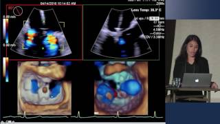 Transesophageal Echocardiography Infective Endocarditis [upl. by Nitnelav]