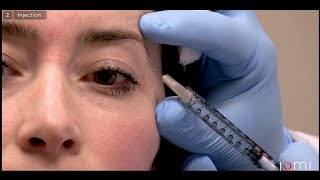 Correcting Unbalanced Botox at His Follow Up Appointment  AAFE [upl. by Obla]