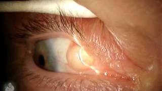 How to manage swollen amp sensitive eyes after injury  Dr Elankumaran P [upl. by Okia]