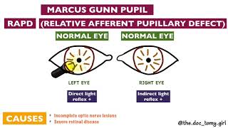 Abnormal Pupillary Reflexes  Ophthalmology [upl. by Flieger]