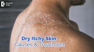 Dry itchy skin all over body Causes Diagnosis Treatment  Dr Rashmi Ravindra  Doctors Circle [upl. by Bayless330]