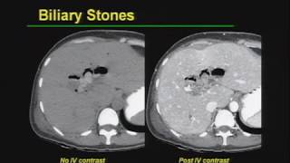 Liver And Bile  Juices In GIT  Part 4  Gastrointestinal Physiology [upl. by Haronid]