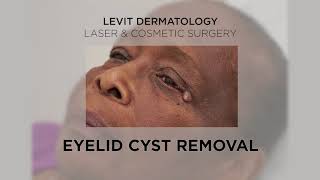 Eyelid Cyst Removal [upl. by Eanerb]