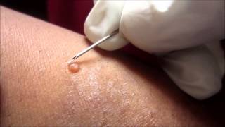 Removing H P Body From Molluscum Contagiosum [upl. by Irmgard]