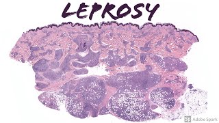 Lepromatous Leprosy Hansen Disease 5Minute Pathology Pearls [upl. by Colleen]