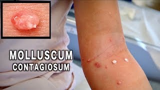 UNUSUAL MOLLUSCUM CONTAGIOSUM Treated with Cryotherapy  Dr Paul [upl. by Eilegna]