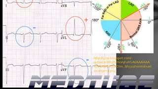 Cardiac Axis Deviations Made Easy [upl. by Anirod250]