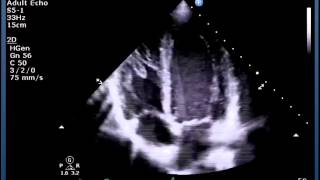 Lecture 9  Aortic Valve Part 1 [upl. by Eeliram]