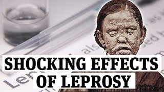 The shocking effects of leprosy [upl. by Stagg]