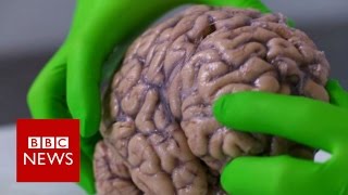 This Brain Implant Could Change Lives [upl. by Dlorah]