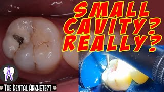 Molar Tooth Caries Removal and Restoration Pasta sa Bagang42 [upl. by Mathian232]