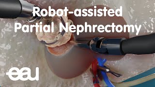 Robotassisted Partial Nephrectomy RAPN [upl. by Airbmak]