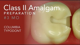 Class II Amalgam Preparation 3 MO [upl. by Seraphim]